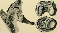 Picture 71 of 224 from The principles and practice of modern surgery / by Roswell Park ... with 722 engravings and 60 full-page plates in colors and monochrome. (1907), leaf 464