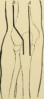 An illustration from The principles and practice of modern surgery / by Roswell Park ... with 722 engravings and 60 full-page plates in colors and monochrome. (1907)