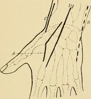 An illustration from The principles and practice of modern surgery / by Roswell Park ... with 722 engravings and 60 full-page plates in colors and monochrome. (1907)