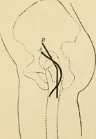 An illustration from The principles and practice of modern surgery / by Roswell Park ... with 722 engravings and 60 full-page plates in colors and monochrome. (1907)