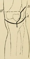 An illustration from The principles and practice of modern surgery / by Roswell Park ... with 722 engravings and 60 full-page plates in colors and monochrome. (1907)