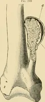 An illustration from The principles and practice of modern surgery / by Roswell Park ... with 722 engravings and 60 full-page plates in colors and monochrome. (1907)