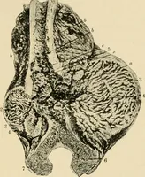 An illustration from The principles and practice of modern surgery / by Roswell Park ... with 722 engravings and 60 full-page plates in colors and monochrome. (1907)