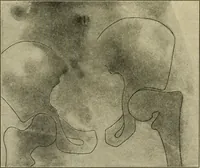 Picture 85 of 224 from The principles and practice of modern surgery / by Roswell Park ... with 722 engravings and 60 full-page plates in colors and monochrome. (1907), leaf 550