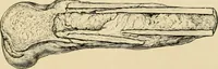An illustration from The principles and practice of modern surgery / by Roswell Park ... with 722 engravings and 60 full-page plates in colors and monochrome. (1907)