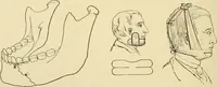 An illustration from The principles and practice of modern surgery / by Roswell Park ... with 722 engravings and 60 full-page plates in colors and monochrome. (1907)