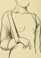 An illustration from The principles and practice of modern surgery / by Roswell Park ... with 722 engravings and 60 full-page plates in colors and monochrome. (1907)