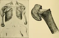 An illustration from The principles and practice of modern surgery / by Roswell Park ... with 722 engravings and 60 full-page plates in colors and monochrome. (1907)