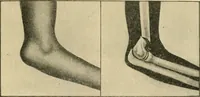 An illustration from The principles and practice of modern surgery / by Roswell Park ... with 722 engravings and 60 full-page plates in colors and monochrome. (1907)