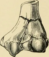 An illustration from The principles and practice of modern surgery / by Roswell Park ... with 722 engravings and 60 full-page plates in colors and monochrome. (1907)
