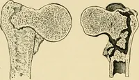 Picture 101 of 224 from The principles and practice of modern surgery / by Roswell Park ... with 722 engravings and 60 full-page plates in colors and monochrome. (1907), leaf 594