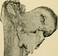 Picture 102 of 224 from The principles and practice of modern surgery / by Roswell Park ... with 722 engravings and 60 full-page plates in colors and monochrome. (1907), leaf 594