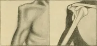 An illustration from The principles and practice of modern surgery / by Roswell Park ... with 722 engravings and 60 full-page plates in colors and monochrome. (1907)