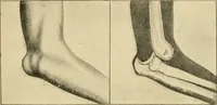 An illustration from The principles and practice of modern surgery / by Roswell Park ... with 722 engravings and 60 full-page plates in colors and monochrome. (1907)