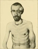 An illustration from The principles and practice of modern surgery / by Roswell Park ... with 722 engravings and 60 full-page plates in colors and monochrome. (1907)