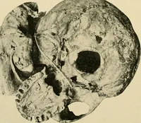 An illustration from The principles and practice of modern surgery / by Roswell Park ... with 722 engravings and 60 full-page plates in colors and monochrome. (1907)