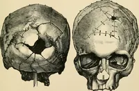 Picture 124 of 224 from The principles and practice of modern surgery / by Roswell Park ... with 722 engravings and 60 full-page plates in colors and monochrome. (1907), leaf 637