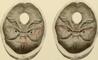 An illustration from The principles and practice of modern surgery / by Roswell Park ... with 722 engravings and 60 full-page plates in colors and monochrome. (1907)