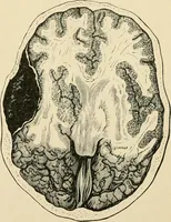 An illustration from The principles and practice of modern surgery / by Roswell Park ... with 722 engravings and 60 full-page plates in colors and monochrome. (1907)