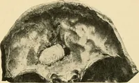 Picture 127 of 224 from The principles and practice of modern surgery / by Roswell Park ... with 722 engravings and 60 full-page plates in colors and monochrome. (1907), leaf 653
