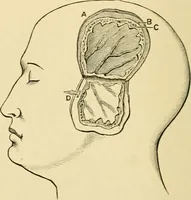 An illustration from The principles and practice of modern surgery / by Roswell Park ... with 722 engravings and 60 full-page plates in colors and monochrome. (1907)