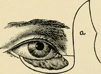 An illustration from The principles and practice of modern surgery / by Roswell Park ... with 722 engravings and 60 full-page plates in colors and monochrome. (1907)