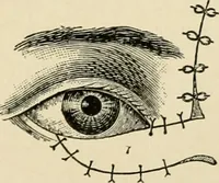An illustration from The principles and practice of modern surgery / by Roswell Park ... with 722 engravings and 60 full-page plates in colors and monochrome. (1907)
