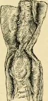 An illustration from The principles and practice of modern surgery / by Roswell Park ... with 722 engravings and 60 full-page plates in colors and monochrome. (1907)