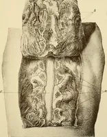 An illustration from The principles and practice of modern surgery / by Roswell Park ... with 722 engravings and 60 full-page plates in colors and monochrome. (1907)