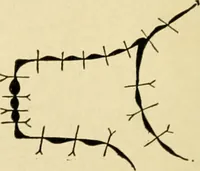 An illustration from The principles and practice of modern surgery / by Roswell Park ... with 722 engravings and 60 full-page plates in colors and monochrome. (1907)