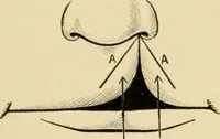 An illustration from The principles and practice of modern surgery / by Roswell Park ... with 722 engravings and 60 full-page plates in colors and monochrome. (1907)