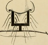 Picture 145 of 224 from The principles and practice of modern surgery / by Roswell Park ... with 722 engravings and 60 full-page plates in colors and monochrome. (1907), leaf 743