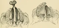 An illustration from The principles and practice of modern surgery / by Roswell Park ... with 722 engravings and 60 full-page plates in colors and monochrome. (1907)