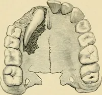 Picture 148 of 224 from The principles and practice of modern surgery / by Roswell Park ... with 722 engravings and 60 full-page plates in colors and monochrome. (1907), leaf 754
