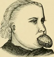 Picture 149 of 224 from The principles and practice of modern surgery / by Roswell Park ... with 722 engravings and 60 full-page plates in colors and monochrome. (1907), leaf 756