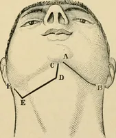 An illustration from The principles and practice of modern surgery / by Roswell Park ... with 722 engravings and 60 full-page plates in colors and monochrome. (1907)