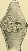 An illustration from The principles and practice of modern surgery / by Roswell Park ... with 722 engravings and 60 full-page plates in colors and monochrome. (1907)