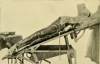 An illustration from The principles and practice of modern surgery / by Roswell Park ... with 722 engravings and 60 full-page plates in colors and monochrome. (1907)