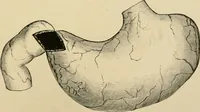 Picture 158 of 224 from The principles and practice of modern surgery / by Roswell Park ... with 722 engravings and 60 full-page plates in colors and monochrome. (1907), leaf 909