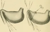 Picture 159 of 224 from The principles and practice of modern surgery / by Roswell Park ... with 722 engravings and 60 full-page plates in colors and monochrome. (1907), leaf 910