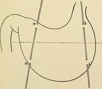 An illustration from The principles and practice of modern surgery / by Roswell Park ... with 722 engravings and 60 full-page plates in colors and monochrome. (1907)
