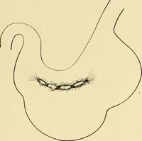 An illustration from The principles and practice of modern surgery / by Roswell Park ... with 722 engravings and 60 full-page plates in colors and monochrome. (1907)