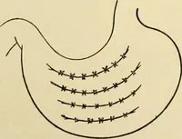 Picture 163 of 224 from The principles and practice of modern surgery / by Roswell Park ... with 722 engravings and 60 full-page plates in colors and monochrome. (1907), leaf 912