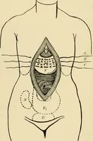 An illustration from The principles and practice of modern surgery / by Roswell Park ... with 722 engravings and 60 full-page plates in colors and monochrome. (1907)