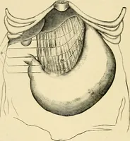 Picture 166 of 224 from The principles and practice of modern surgery / by Roswell Park ... with 722 engravings and 60 full-page plates in colors and monochrome. (1907), leaf 914