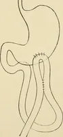 An illustration from The principles and practice of modern surgery / by Roswell Park ... with 722 engravings and 60 full-page plates in colors and monochrome. (1907)