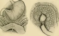 Picture 169 of 224 from The principles and practice of modern surgery / by Roswell Park ... with 722 engravings and 60 full-page plates in colors and monochrome. (1907), leaf 919