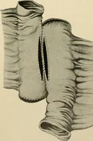 An illustration from The principles and practice of modern surgery / by Roswell Park ... with 722 engravings and 60 full-page plates in colors and monochrome. (1907)