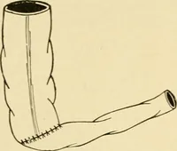 Picture 175 of 224 from The principles and practice of modern surgery / by Roswell Park ... with 722 engravings and 60 full-page plates in colors and monochrome. (1907), leaf 950