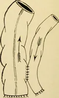 Picture 176 of 224 from The principles and practice of modern surgery / by Roswell Park ... with 722 engravings and 60 full-page plates in colors and monochrome. (1907), leaf 950